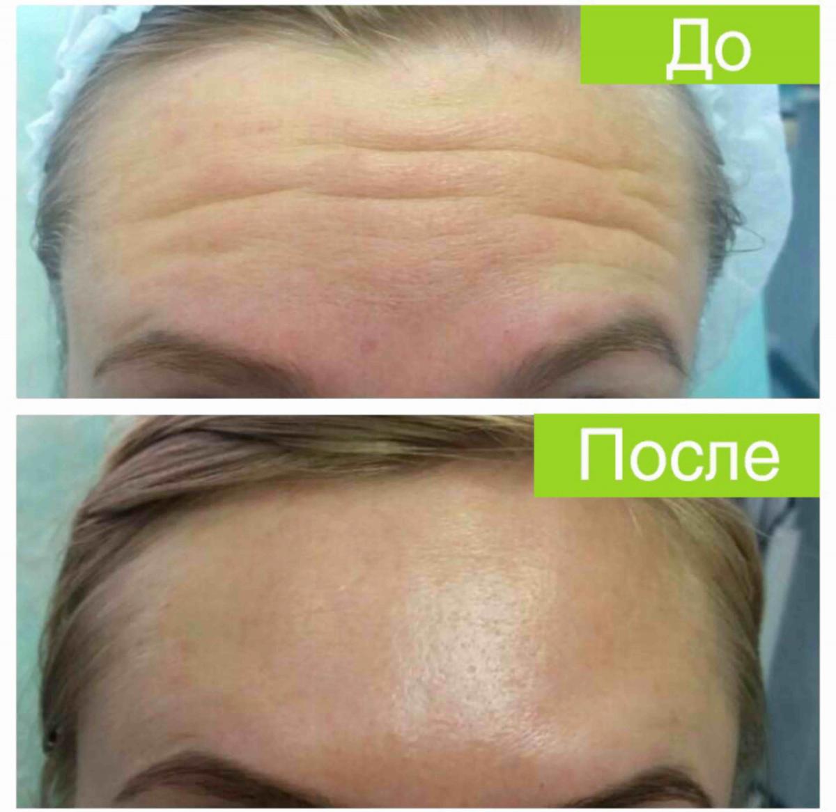 БОТУЛИНОТЕРАПИЯ БОТУЛИНОТЕРАПИЯ