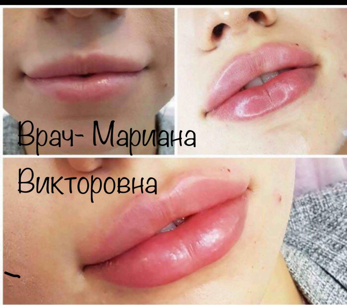 ФИЛЛИНГ ГУБ