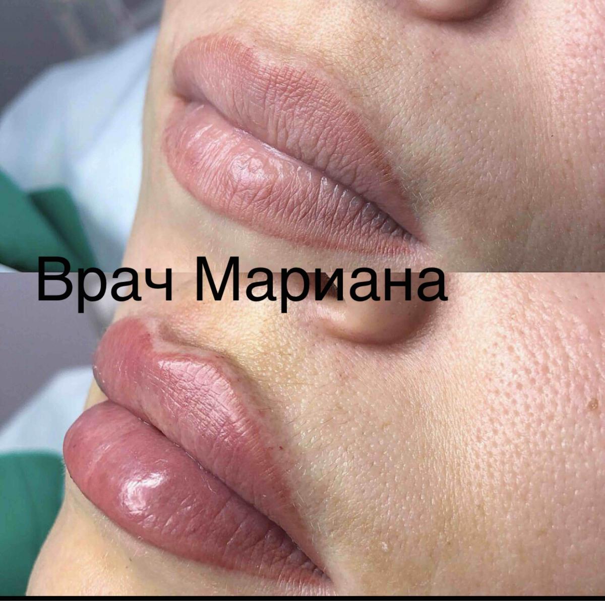 ФИЛЛИНГ ГУБ