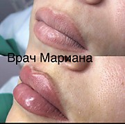 ФИЛЛИНГ ГУБ
