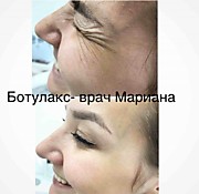 БОТУЛИНОТЕРАПИЯ
